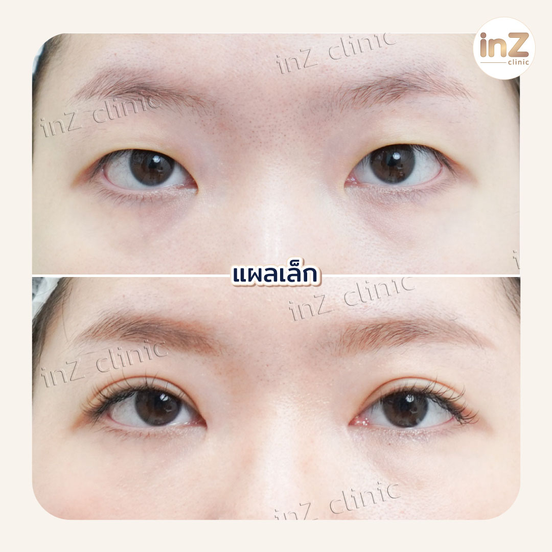 Small Incision Blepharoplasty