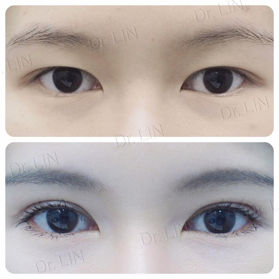 เทคนิคศัลยกรรมตาสองชั้นกรีดยาว_หมอหลิน_04