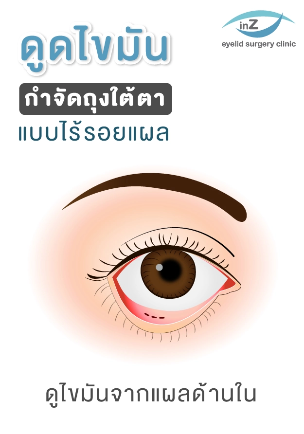ตัวอย่างการดูดไขมันกำจัดถุงใต้ตา