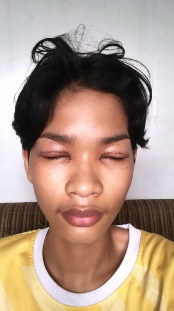 รีวิวตาสองชั้น_คุณป๊อกแป๊ก_Big eye surgery05