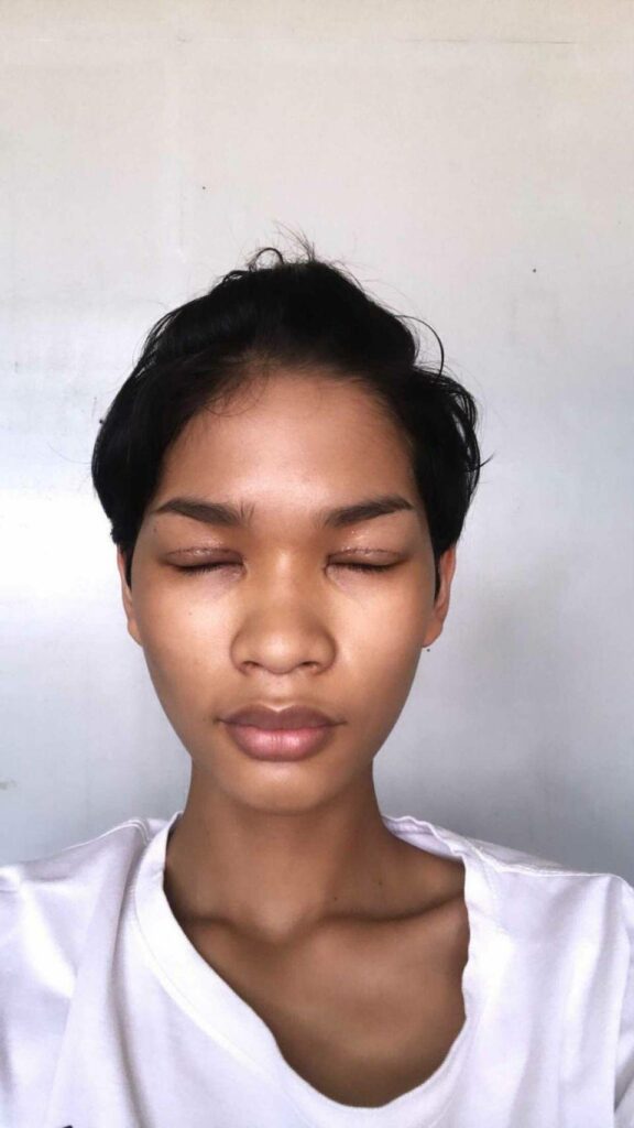รีวิวตาสองชั้น_คุณป๊อกแป๊ก_Big eye surgery11