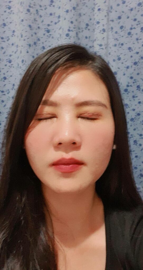 รีวิวตาสองชั้น_คุณบอส_กรีดยาวและเปิดหัวตา08