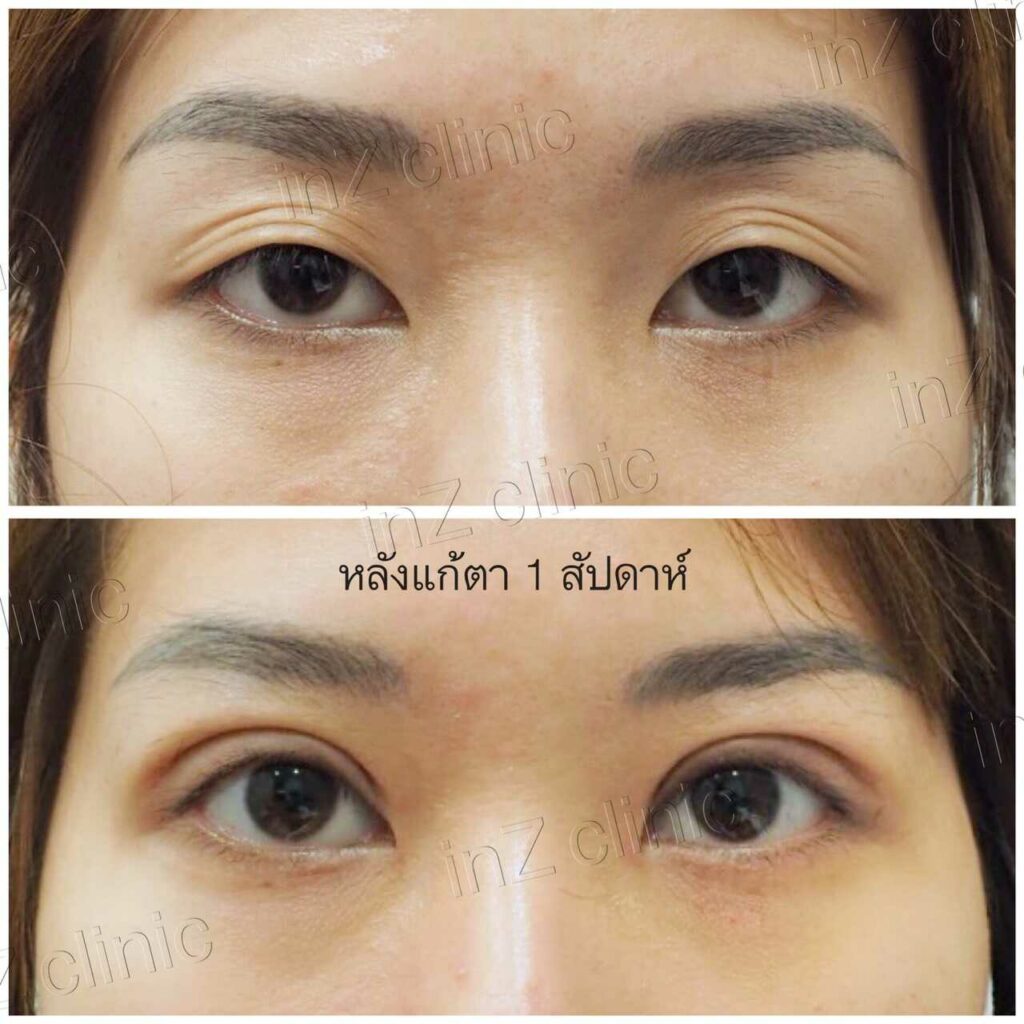 งานแก้ตาสองชั้น_กล้ามเนื้อตาอ่อนแรง02