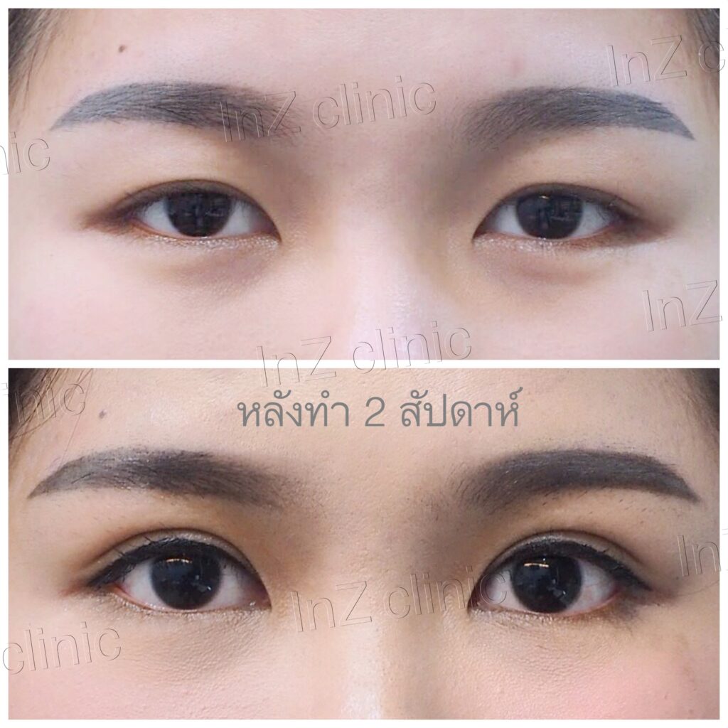 การเตรียมตัวทำตาสองชั้น_inzclinic 08