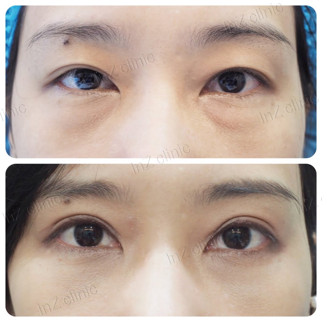 รีวิว ผ่าตัดดถุงใต้ตา03