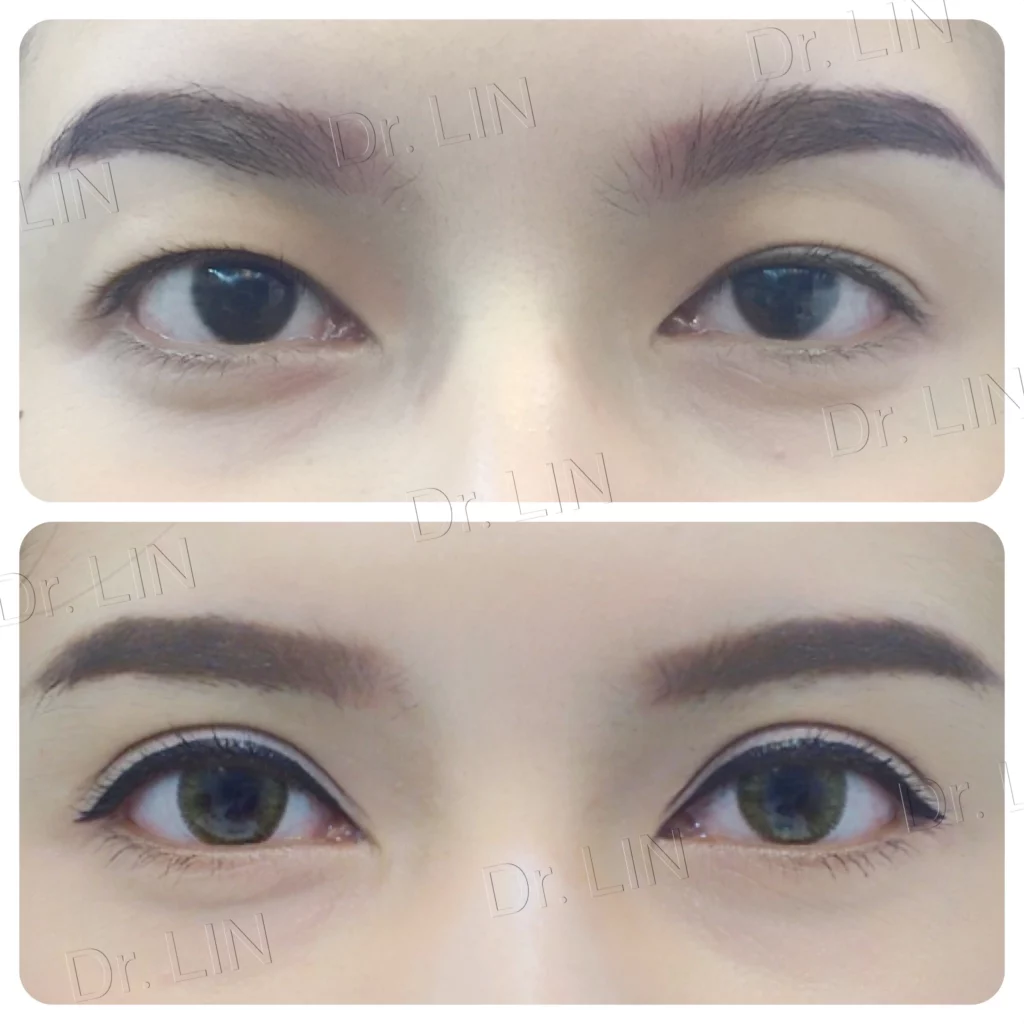 รีวิว วิธีทำตา ปัญหาตาไม่เท่ากัน 03