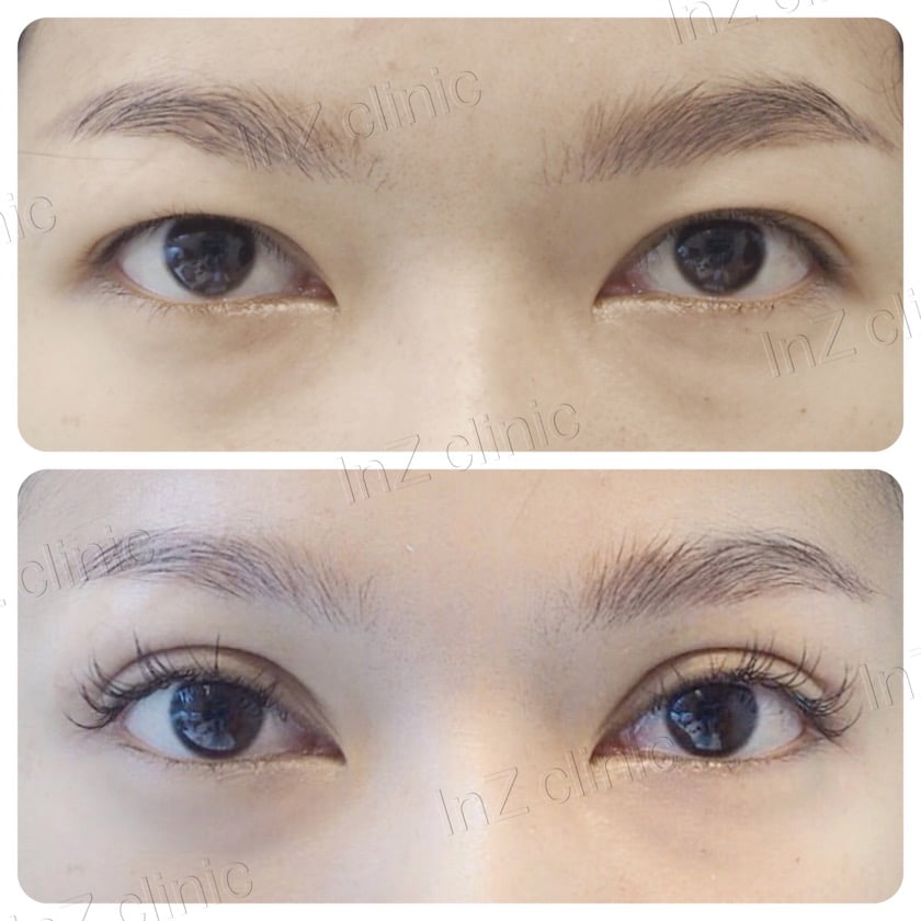 รีวิว วิธีทำตา ปัญหาหนังตาตก 02