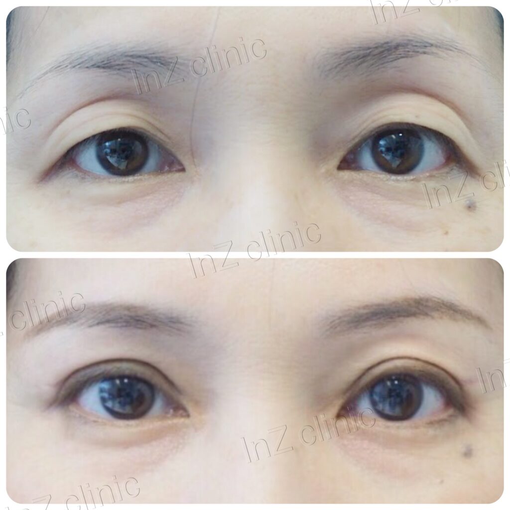 รีวิว วิธีทำตา ปัญหาหนังตาตก 03