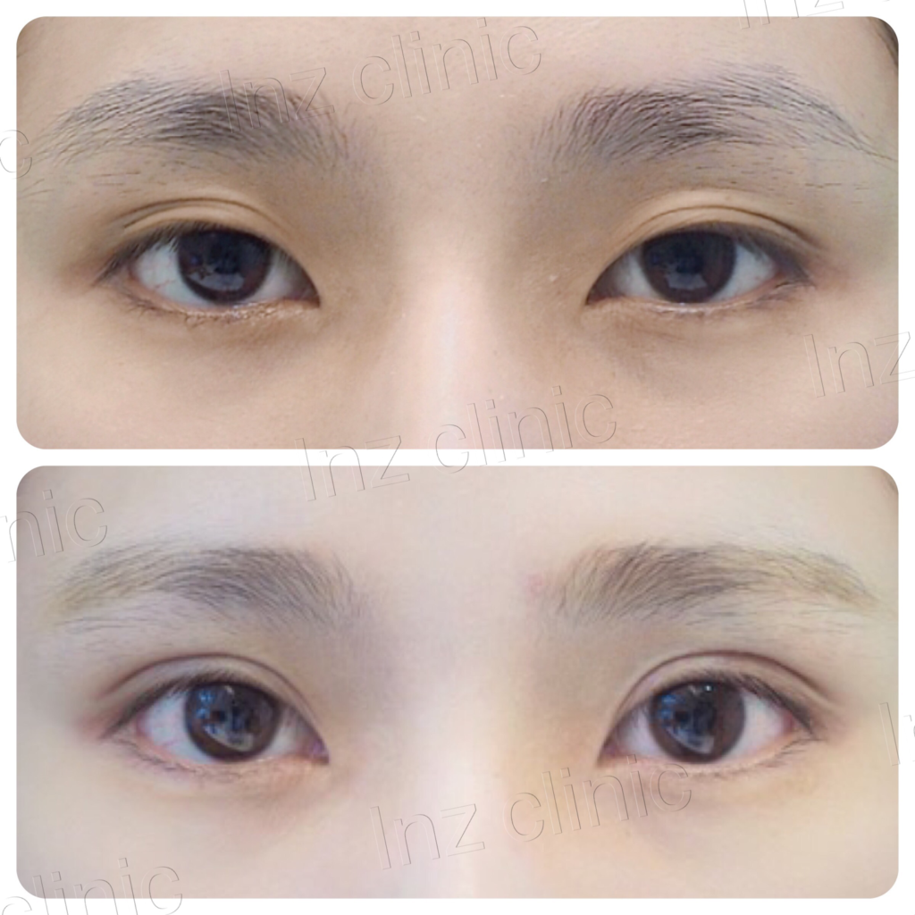 รีวิว วิธีทำตา ปัญหาตาเล็ก 03