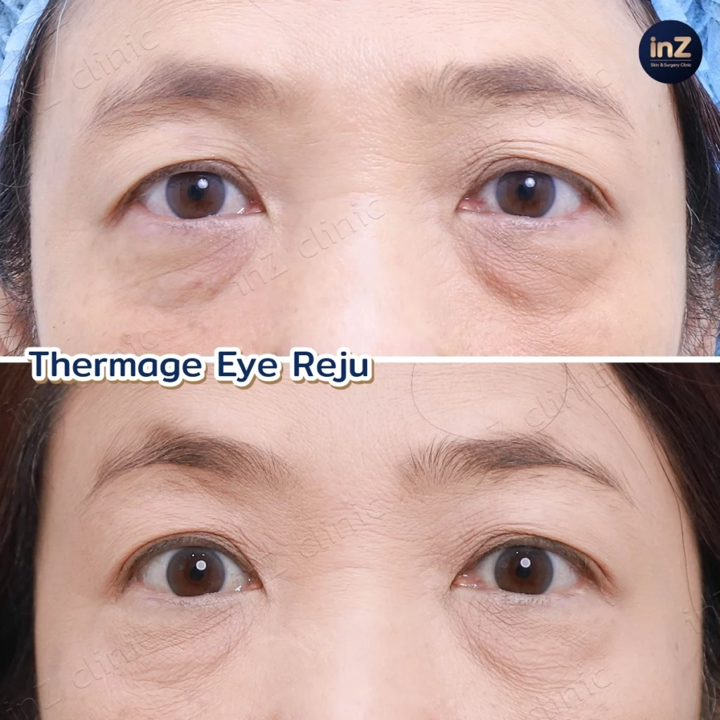 ภาพรีวิว Thermage Eye Reju 01