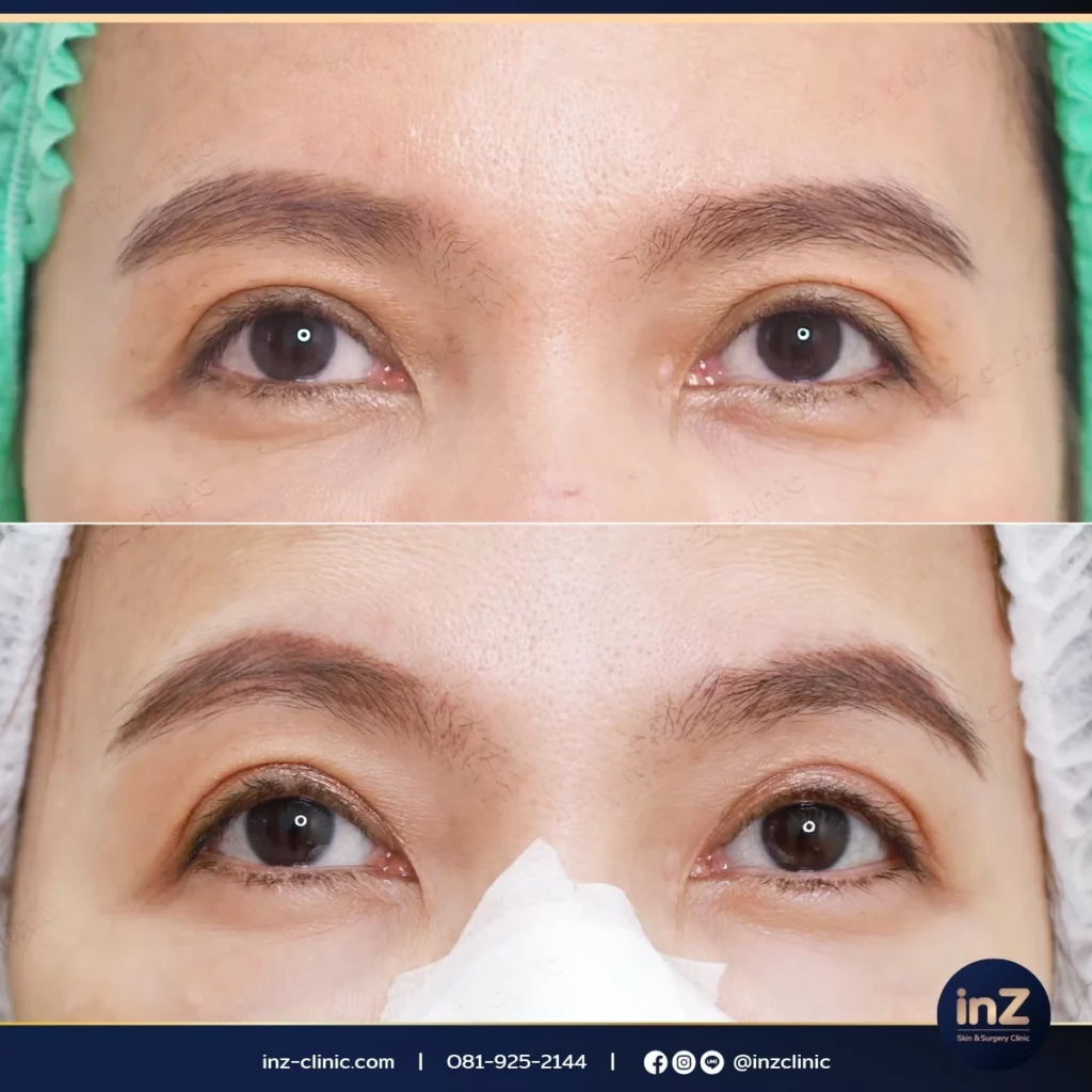 ภาพรีวิว Thermage Eye Reju 04