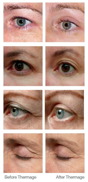 ภาพรีวิว Thermage Eye Reju 07