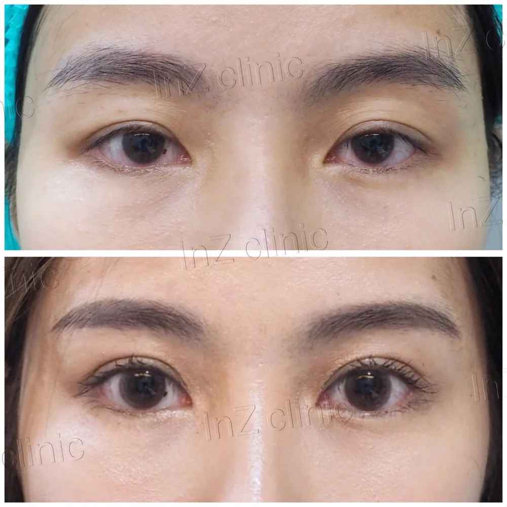 ภาพรีวิวทำตาสองชั้น เทคนิค Big eye surgery 02