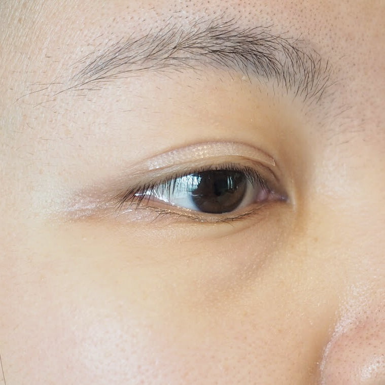 ภาพตัวอย่างการติดสติ๊กเกอร์ตาสองชั้น