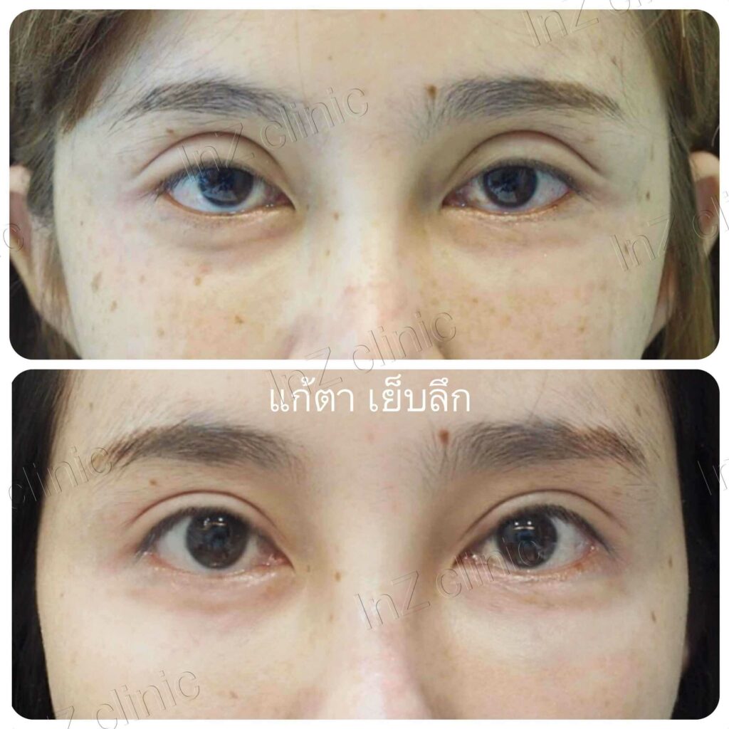 ภาพรีวิวแก้ไขตาสองชั้น 02