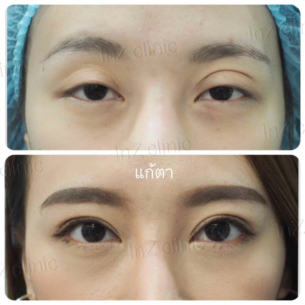 ภาพรีวิวแก้ไขตาสองชั้น 03
