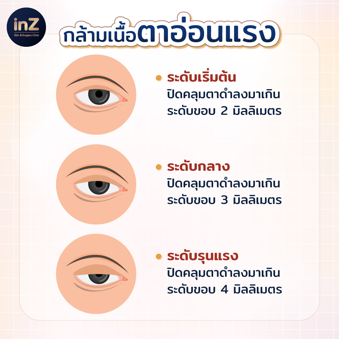 "ภาวะกล้ามเนื้อตาอ่อนแรง" ปัญหาซ่อนเร้นของการทำตา 2 ชั้น