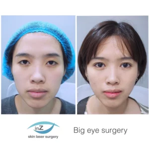 ศัลยกรรมตาทำให้ใบหน้าอ่อนวัย