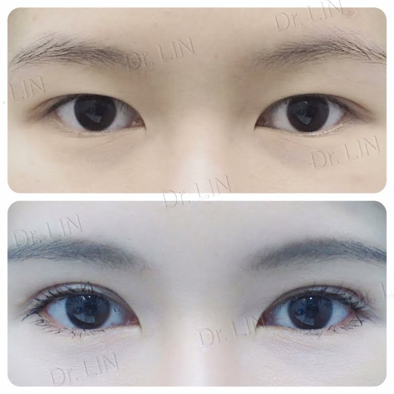Current Methods Of Double Eyelid Surgery Pros And Cons Inz Clinic 