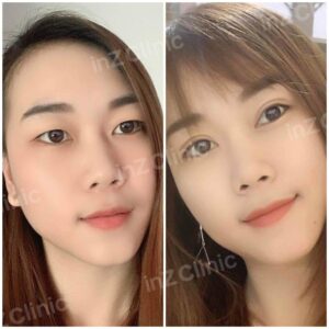 ตาสองชั้นทีมจักษุแพทย์