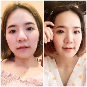 ตาสองชั้นทีมจักษุแพทย์