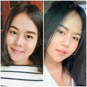 ตาสองชั้นทีมจักษุแพทย์