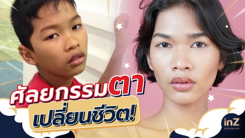 รีวิวตาสองชั้น_คุณป๊อกแป๊ก_Big eye surgery01