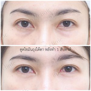 Liposuction bags under the eyes ophthalmologist team-72