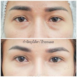 Liposuction bags under the eyes ophthalmologist team-73