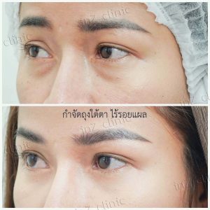 Liposuction bags under the eyes ophthalmologist team-74