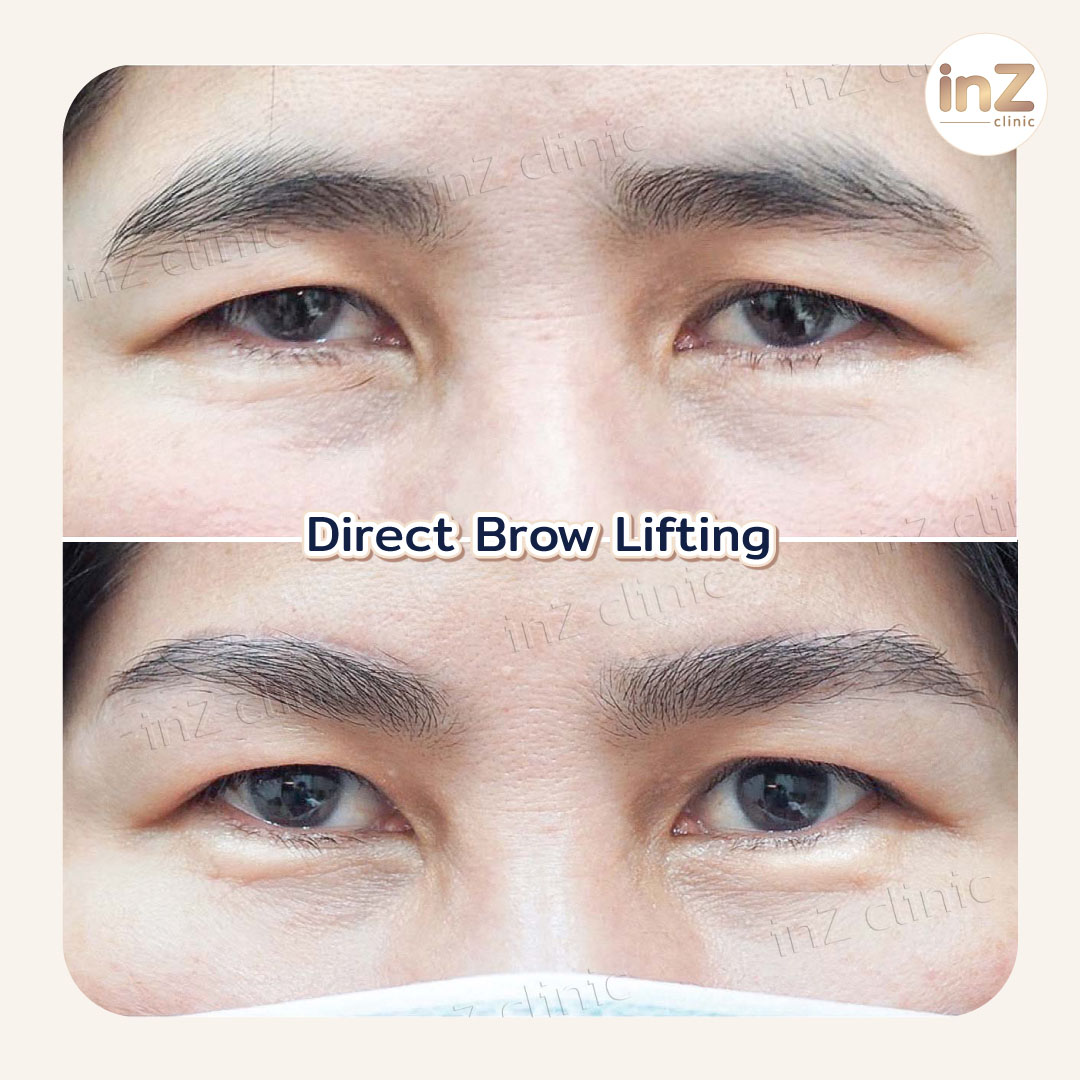 Direct Brow lift