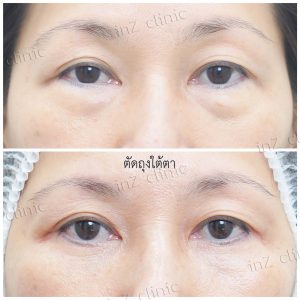 Liposuction bags under the eyes ophthalmologist team-75