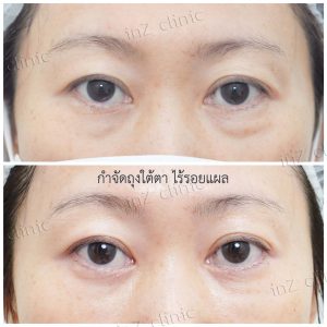 Liposuction bags under the eyes ophthalmologist team-77