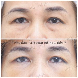 Liposuction bags under the eyes ophthalmologist team-78