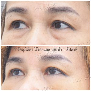 Liposuction bags under the eyes ophthalmologist team-79