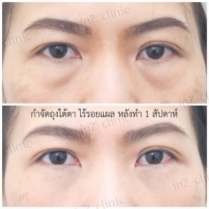 Liposuction bags under the eyes ophthalmologist team-80