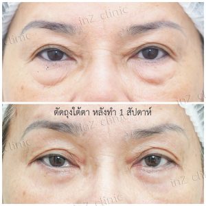 Liposuction bags under the eyes ophthalmologist team-81