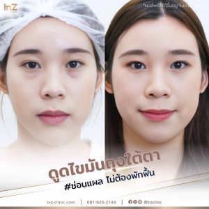 Liposuction bags under the eyes ophthalmologist team-83