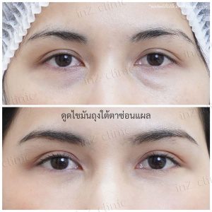 Liposuction bags under the eyes ophthalmologist team-88