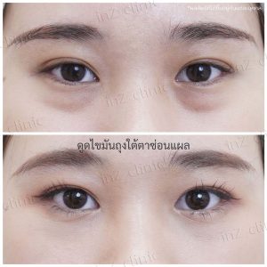 Liposuction bags under the eyes ophthalmologist team-89