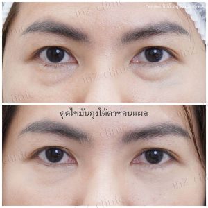 Liposuction bags under the eyes ophthalmologist team-90