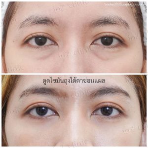 Liposuction bags under the eyes ophthalmologist team-91