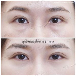 Liposuction bags under the eyes ophthalmologist team-92