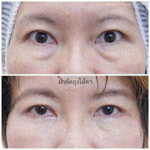 Liposuction bags under the eyes ophthalmologist team-85