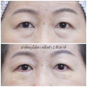 Liposuction bags under the eyes ophthalmologist team-86