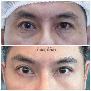 Liposuction bags under the eyes ophthalmologist team-87