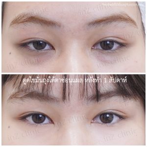 Liposuction bags under the eyes ophthalmologist team-93