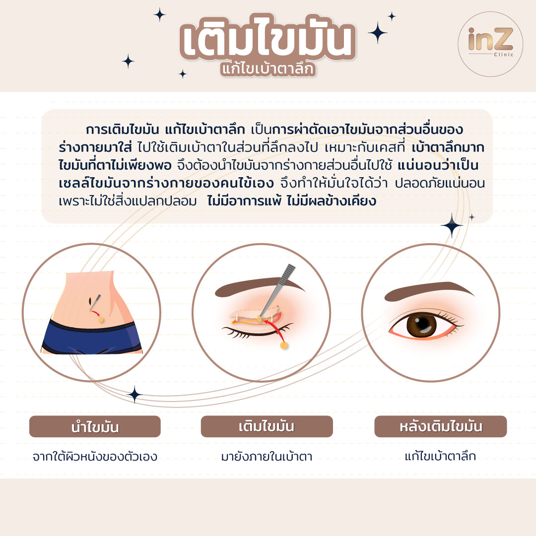 เติมไขมันตาสองชั้น