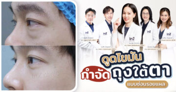 ดูดไขมันกำจัดถุงใต้ตา ซ่อนรอยแผล