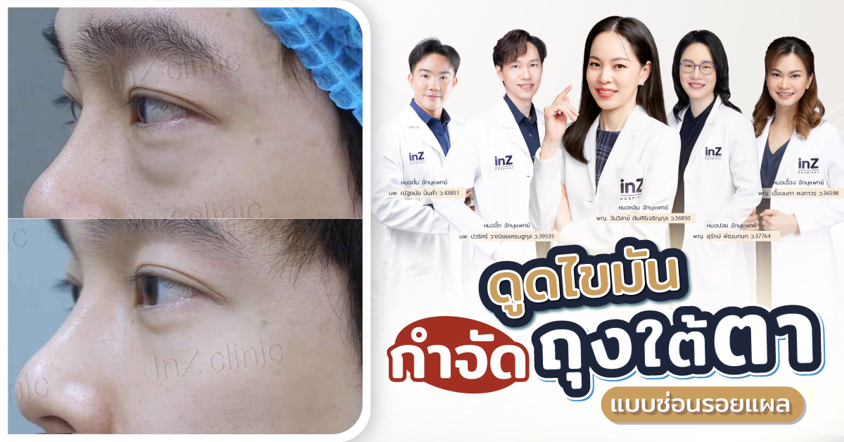 ดูดไขมันกำจัดถุงใต้ตา ซ่อนรอยแผล